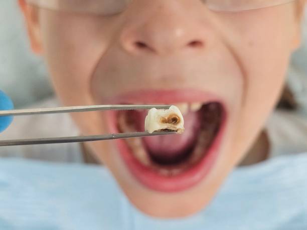 Best Emergency Treatment for Oral Infections in Bells, TX